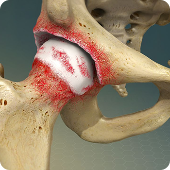 Osteoarthritis