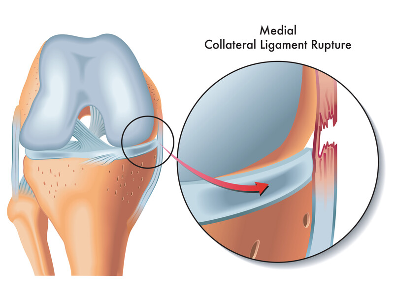 Before MCL Treatment