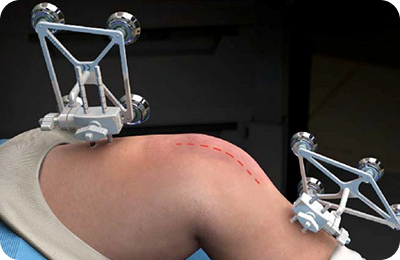 Robotic Uni Knee Replacement