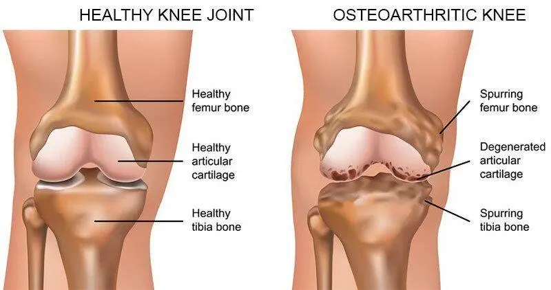Before Knee Treatment